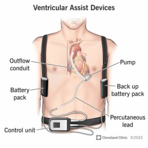 22600 ventricular assist devices