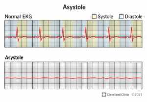 22920 asystole