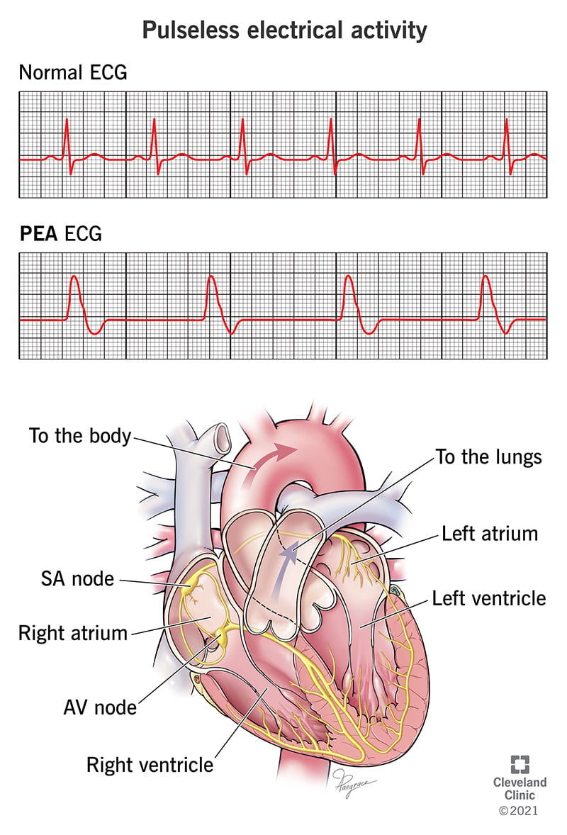 EKG, kas ilustrē bezimpulsu elektrisko aktivitāti (PEA)