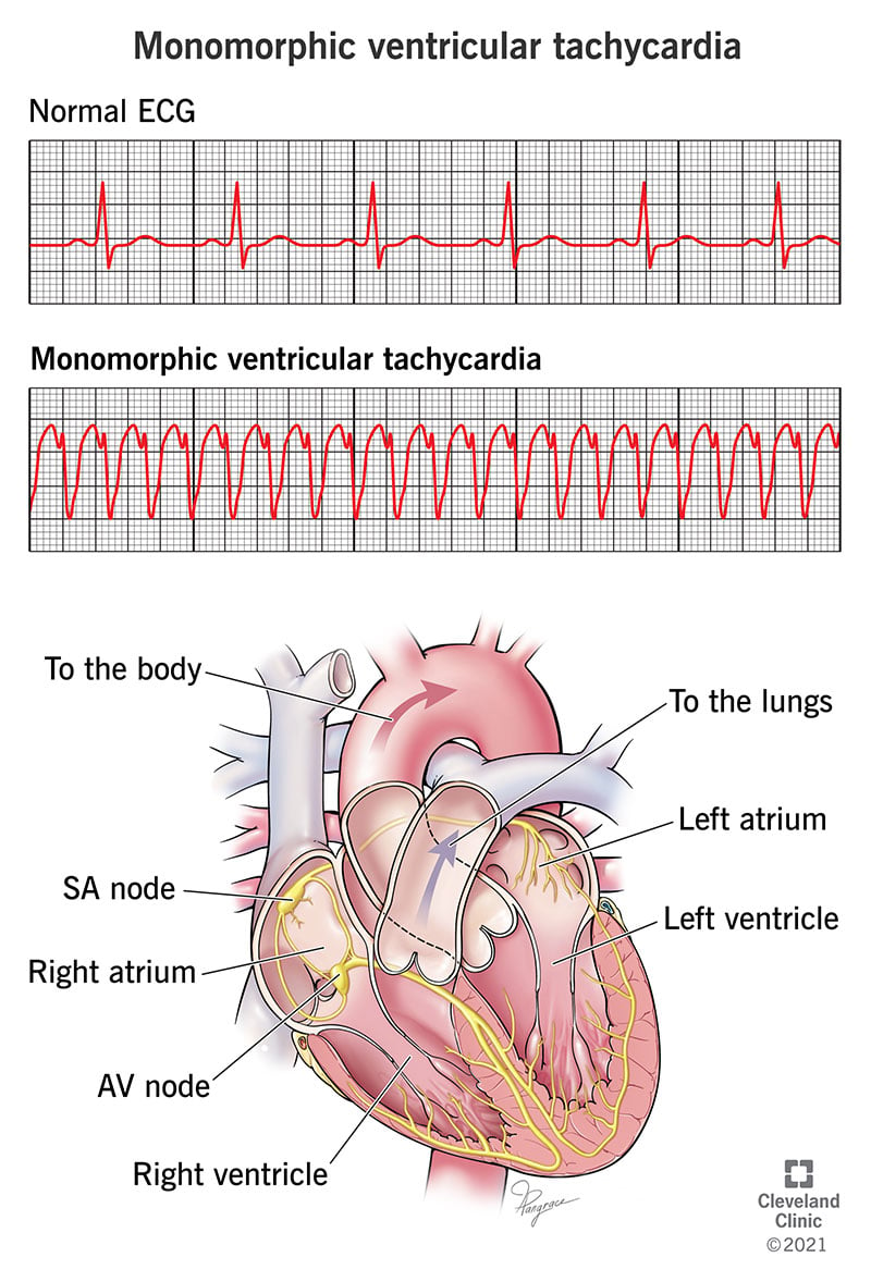 EKG, kas parāda monomorfisku kambaru tahikardiju.