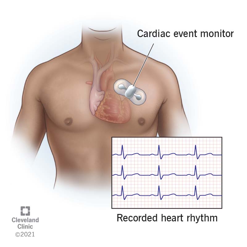 23272 cardiac event monitor