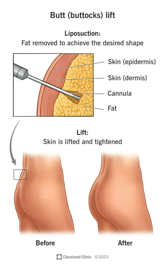 24241 butt buttocks lift