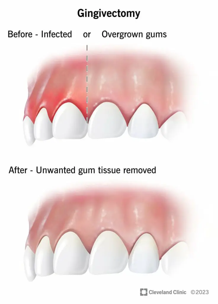 24749 gingivectomy