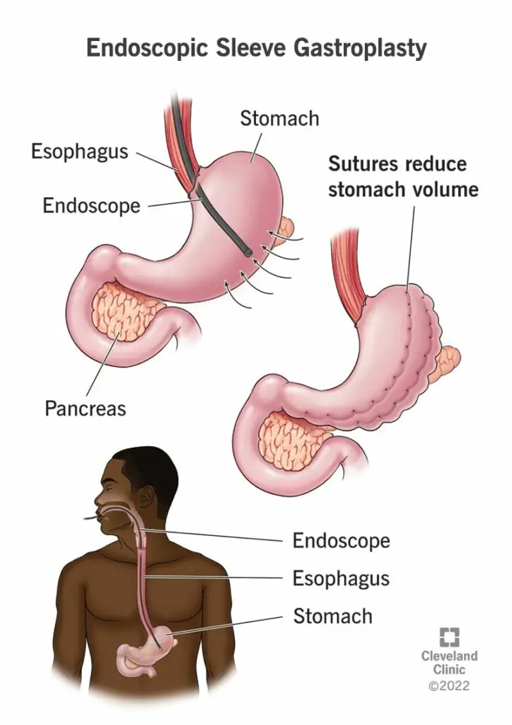 24771 endoscopic sleeve gastroplasty