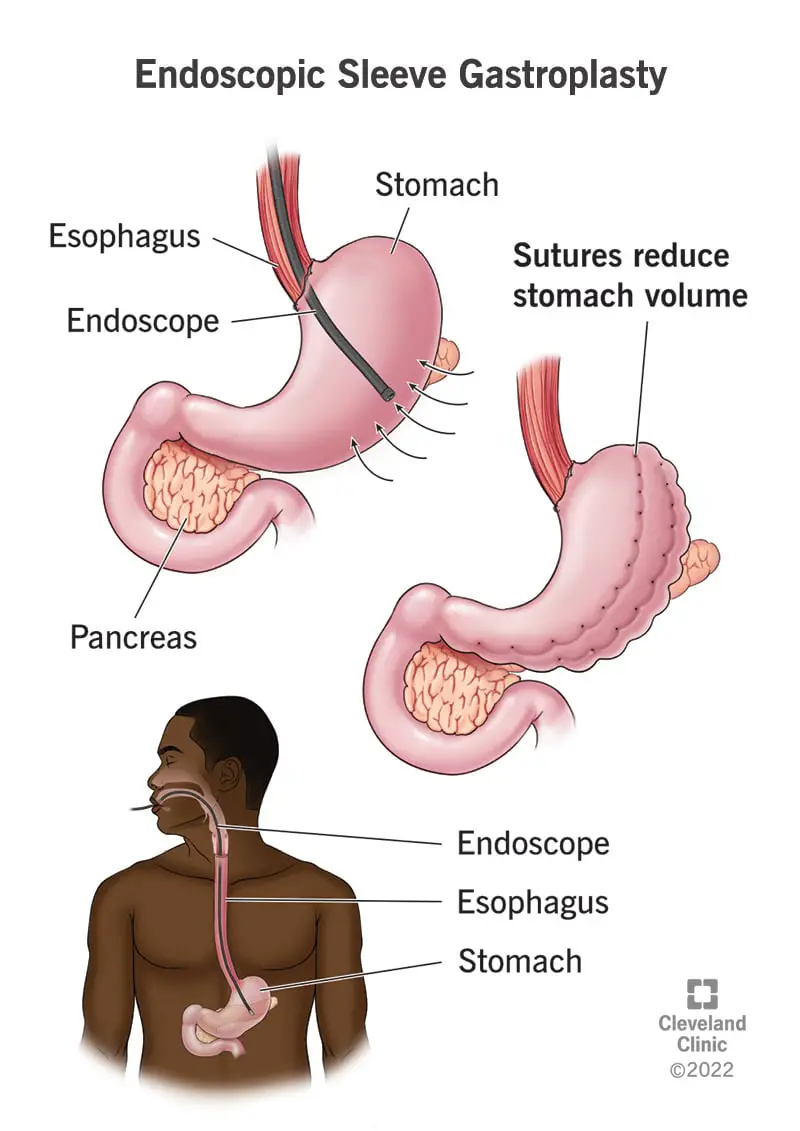 Endoskopiskā piedurknes gastroplastika samazina kuņģa tilpumu, noslēdzot daļu ar šuvēm.