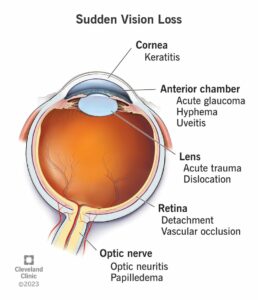 24803 vision loss