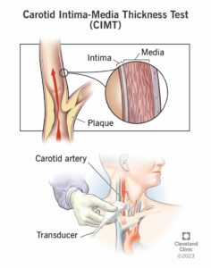 24944 carotid intima media thickness test