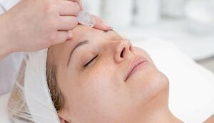 25124 microdermabrasion