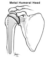Metāla pleca kaula galvas ilustrācija plecā.