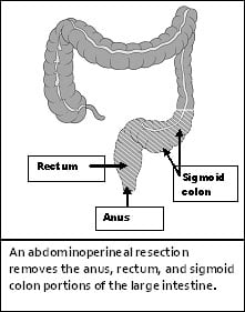 abdominoperineālā rezekcija