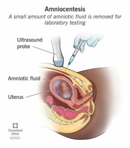 4206 genetic amniocentesis