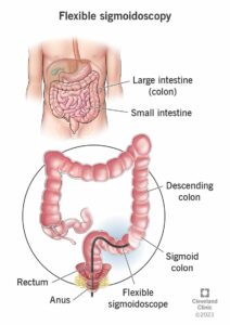 4953 flexible sigmoidoscopy