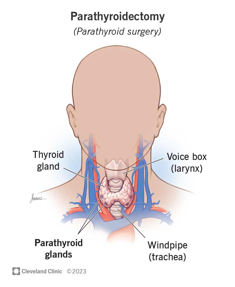 7015 parathyroid surgery