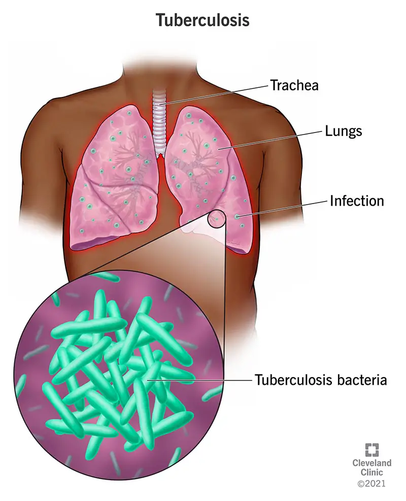 Jūsu plaušas, kas savienotas ar traheju, ir inficētas ar tuberkulozes baktērijām, izraisot tuberkulozi.