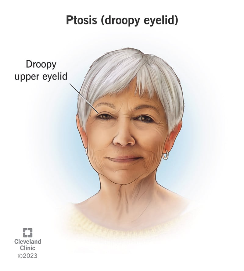 14418 ptosis