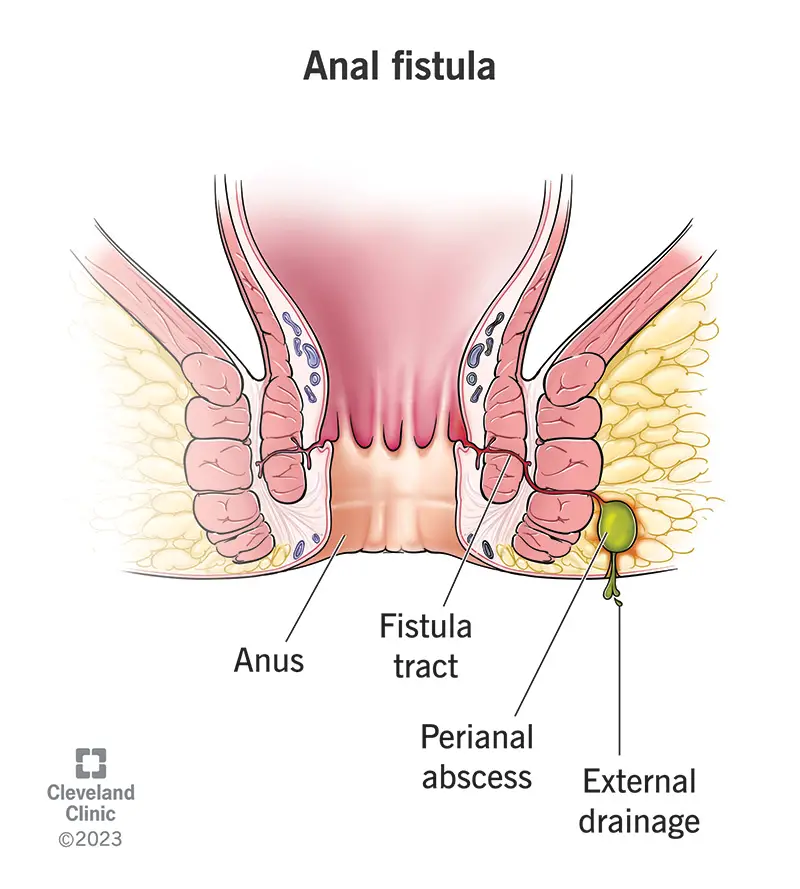 Anālā fistula, kas ved no anālā kanāla sienas uz sēžamvietas ārējo ādu.