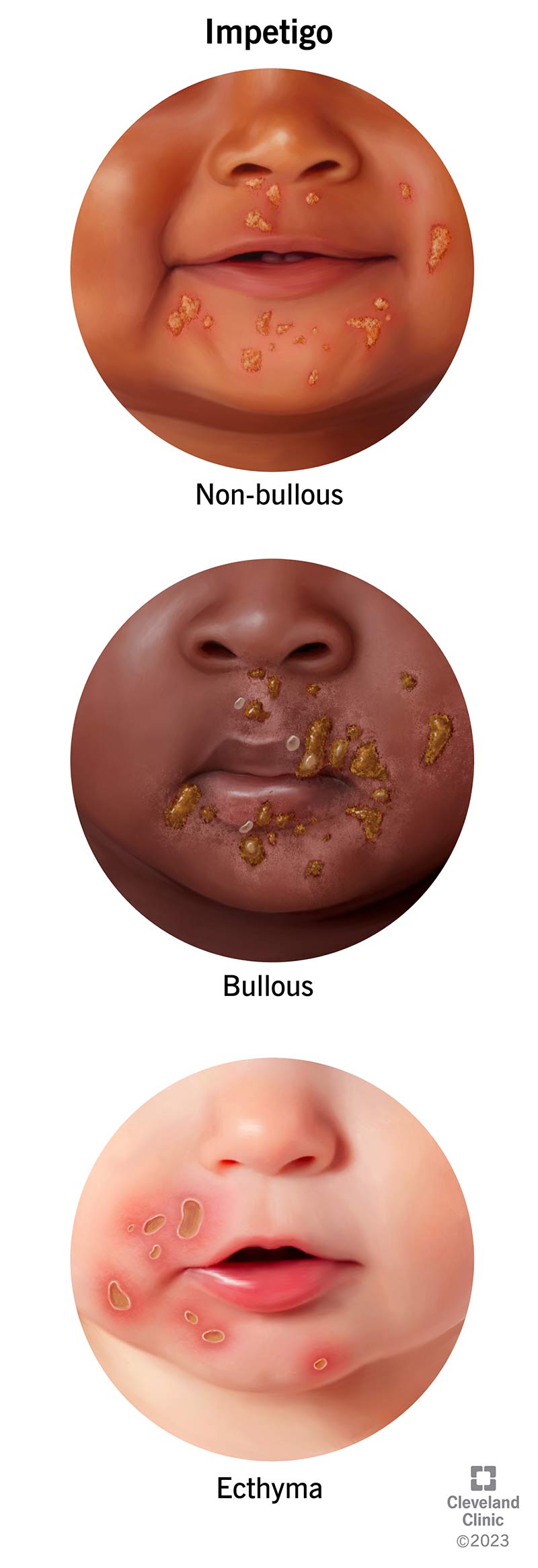 Trīs impetigo stadijas: bezbulozs, bullozs un ektīma.