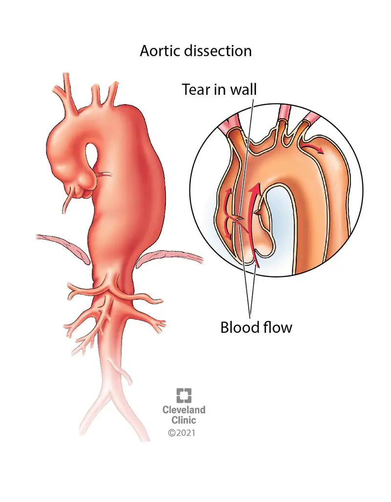 Aortas sadalīšana ir aortas sienas iekšējā slāņa plīsums.  Asinis izplūst cauri asarai, izraisot sienas slāņu atdalīšanu, artērijas izliekumu un vājumu šajā aortas zonā.