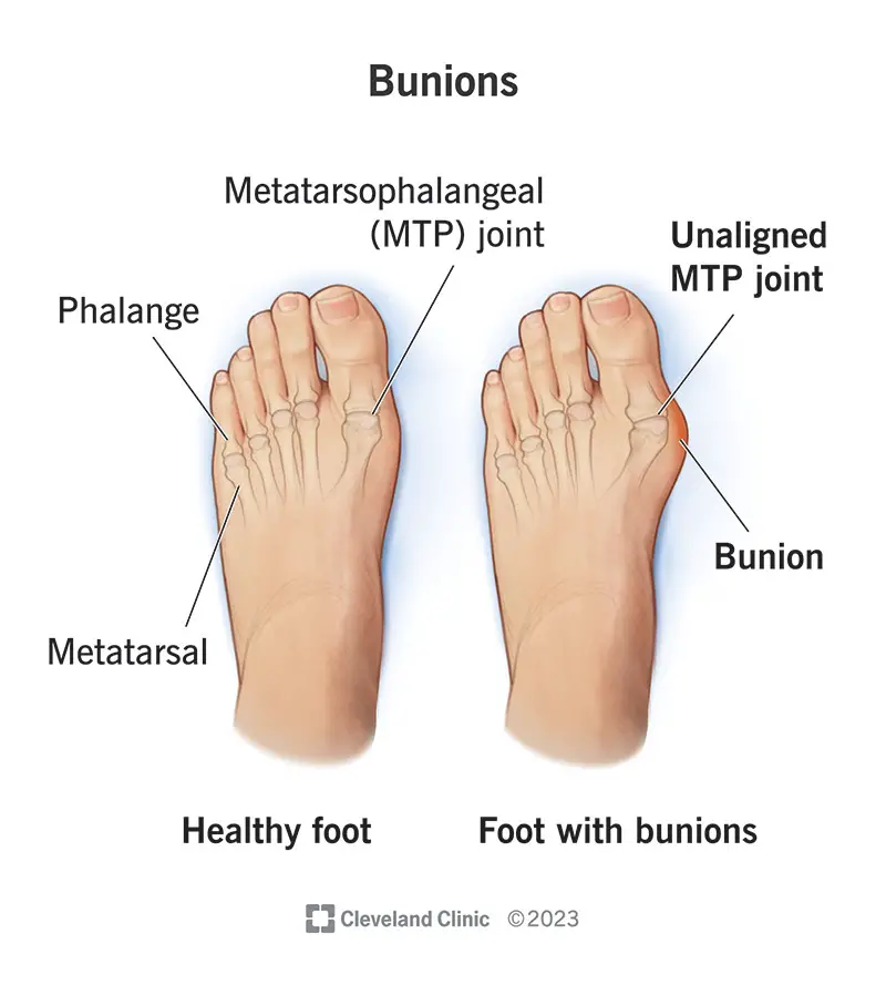 1705057404 bunions