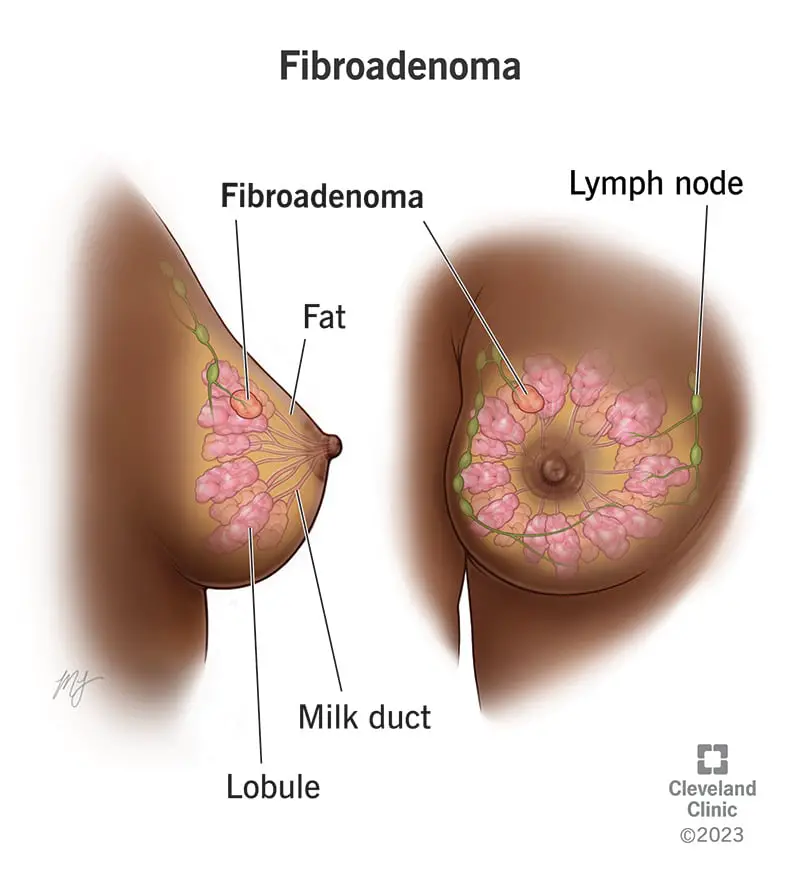 1705121414 15690 fibroadenomas of the breast