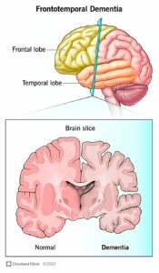 1705126102 21075 frontotemporal dementia