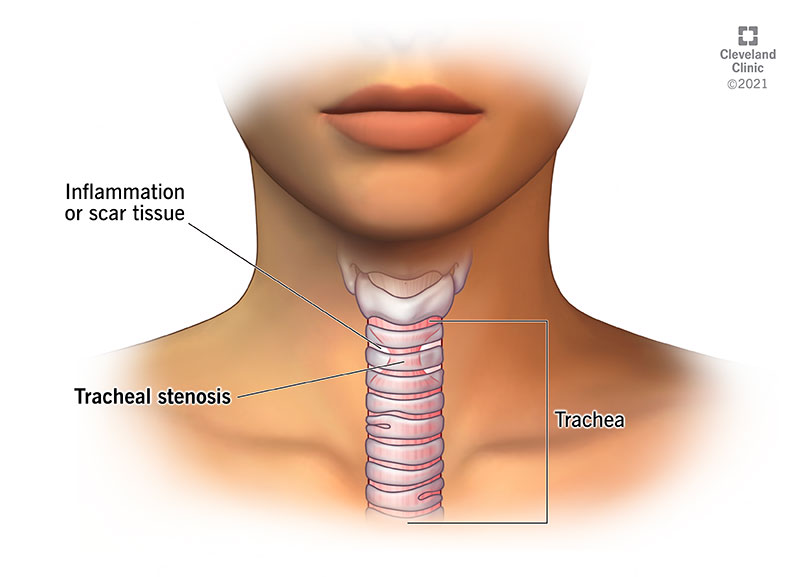 1705153463 21866 tracheal stenosis