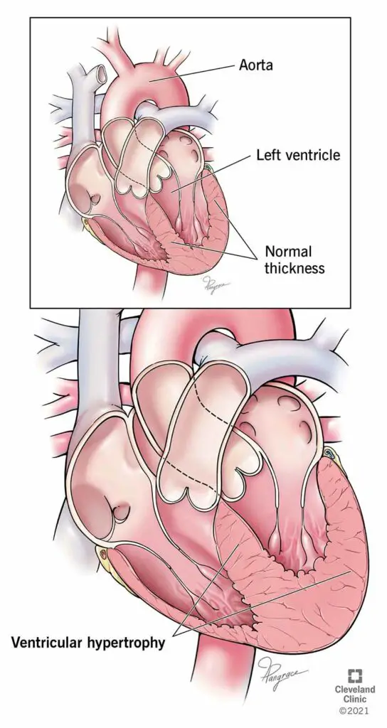 1705199114 21883 left ventricular hypertrophy illustration