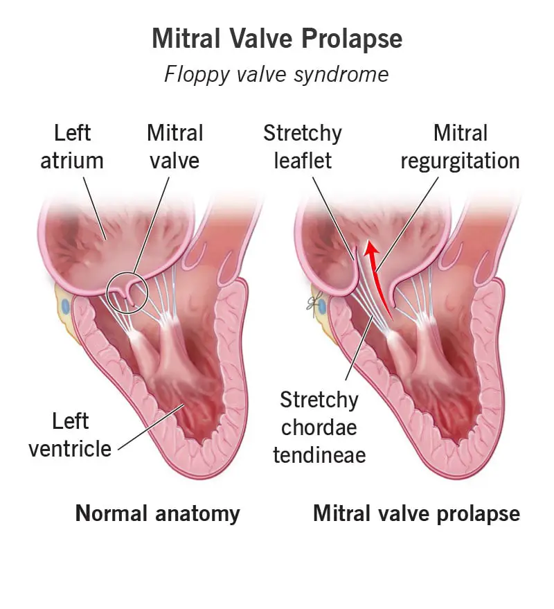 1705217361 17241 mitral valve prolapse