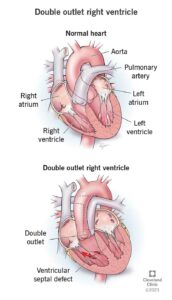 1705240163 double outlet right ventricle