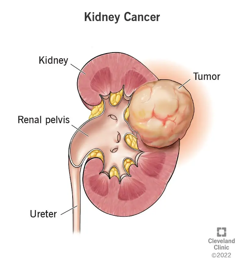 1705253843 9409 kidney cancer