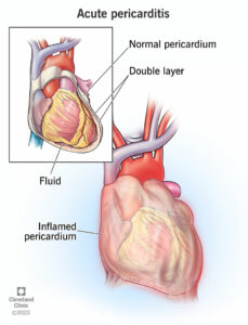 1705326802 22918 acute pericarditis