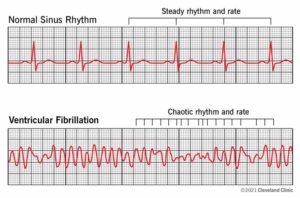 1705358716 21878 ventricular fibrillation illustration