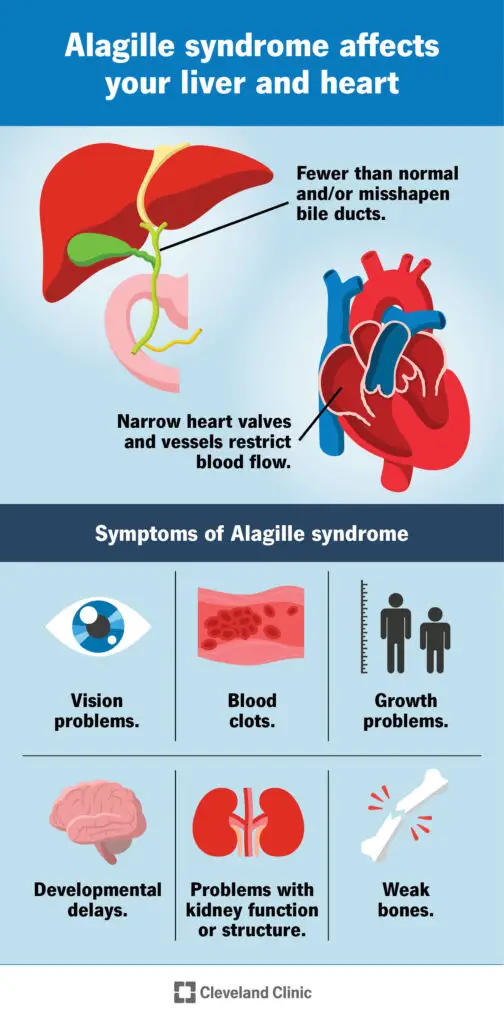 1705367898 23540 alagille syndrome