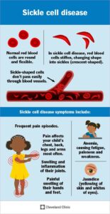 1705372459 12100 sickle cell disease