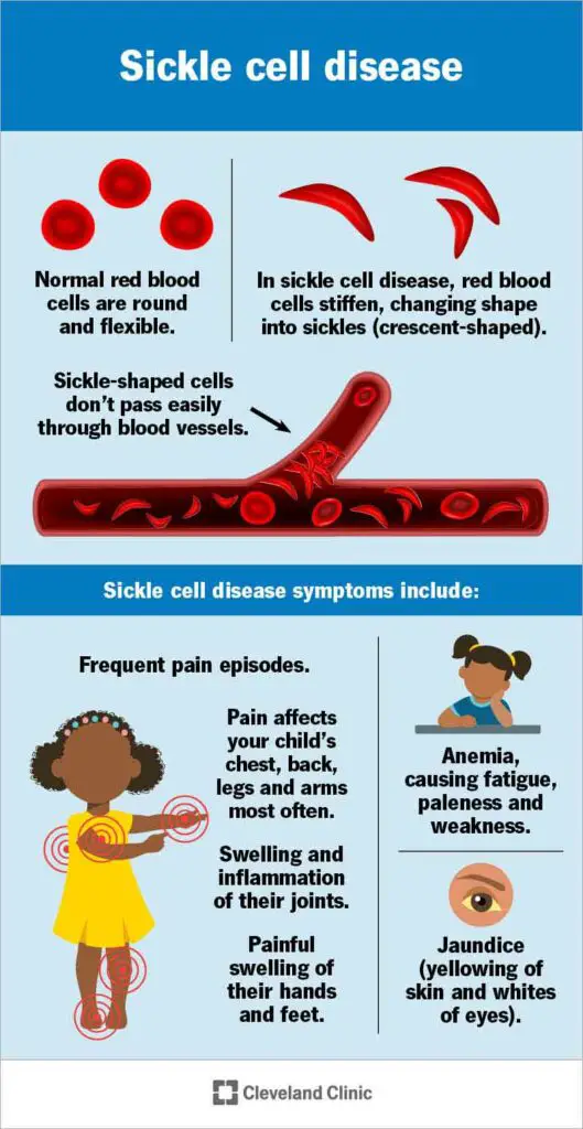 1705372459 12100 sickle cell disease