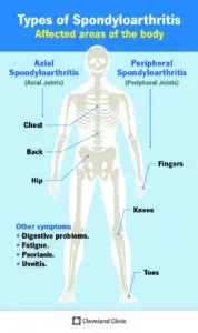 1705422740 24843 axial spondyloarthritis infographic