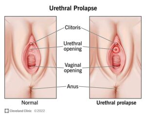 1705473138 24177 urethral prolapse