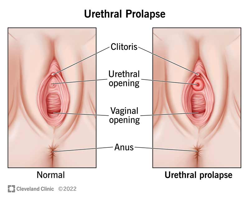 1705473138 24177 urethral prolapse