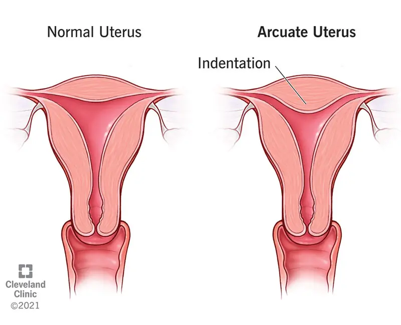 1705477758 22811 arcuate uterus