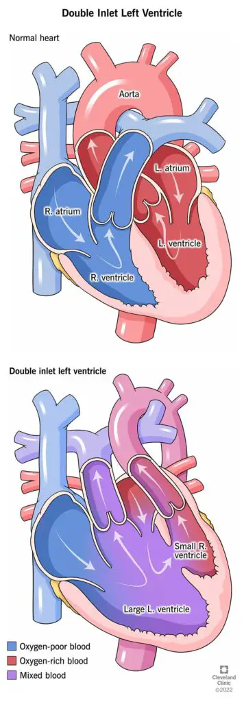 1705541778 14786 double inlet left ventricle