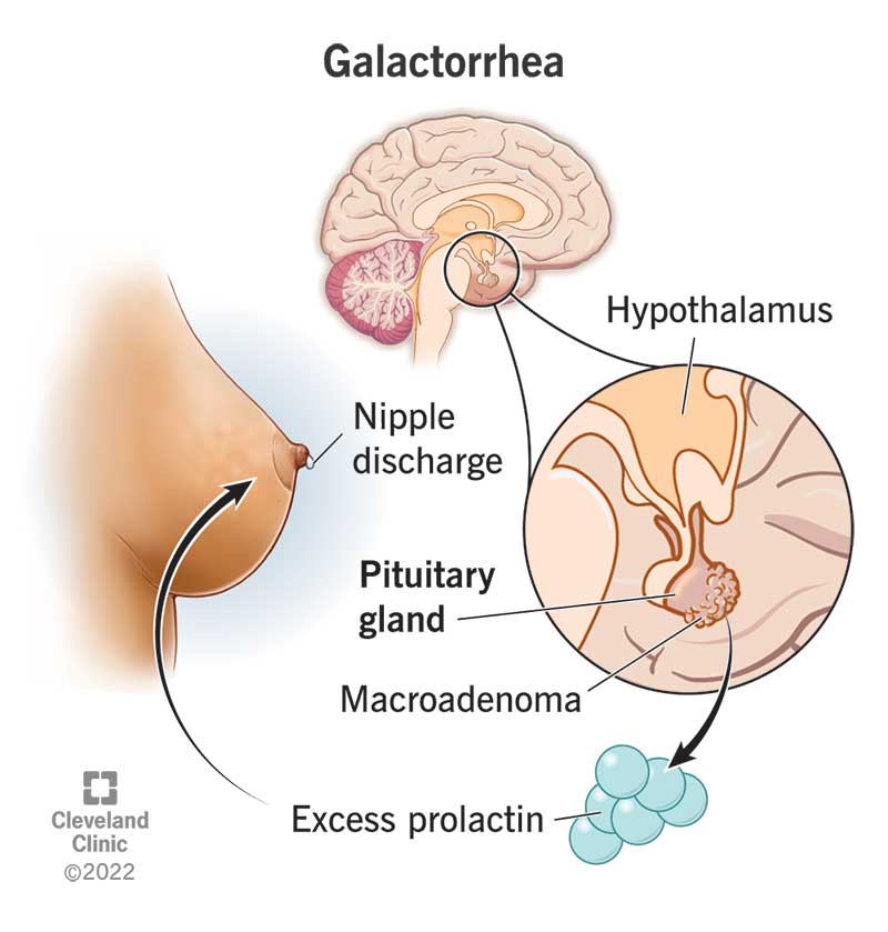 1705587524 17924 galactorrhea