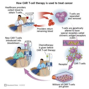 1705648825 17726 car t cell therapy