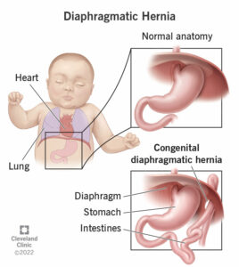 1705651350 24308 diaphragmatic hernia