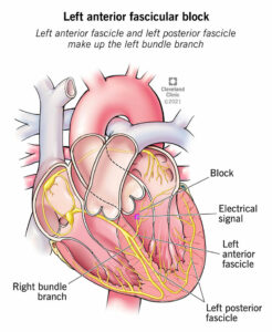 1705674259 23212 left anterior fascicular block