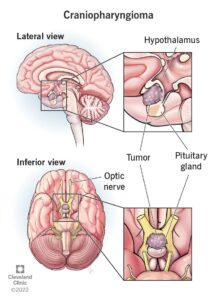 1705706178 22989 craniopharyngioma