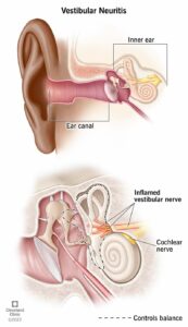 1705715301 15227 vestibular neuritis