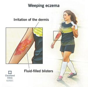 1705747402 21991 weeping eczema