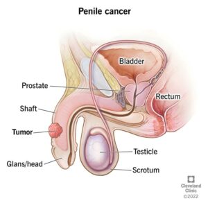 1705765644 6181 penile cancer