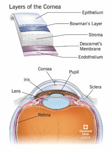 1705792878 17714 cornea transplant