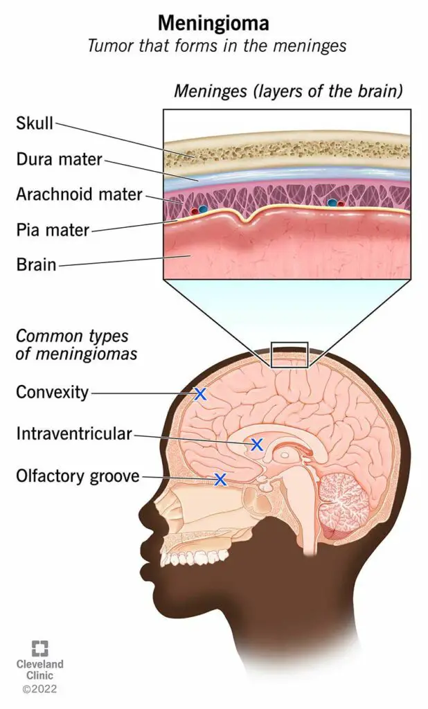 1705815983 17858 meningioma